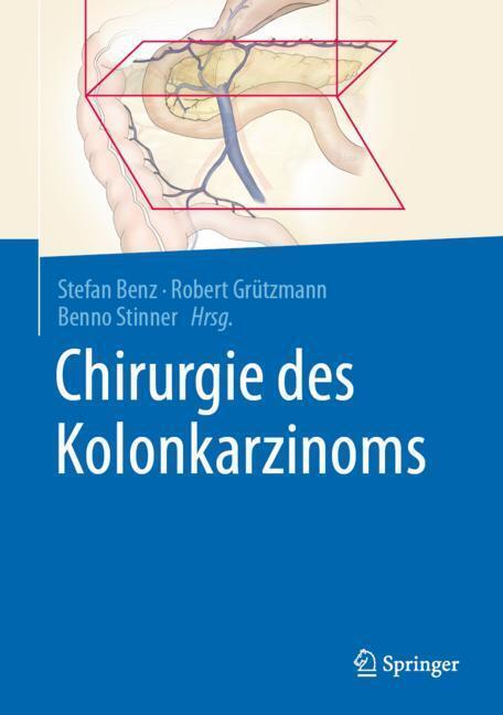 Chirurgie des Kolonkarzinoms