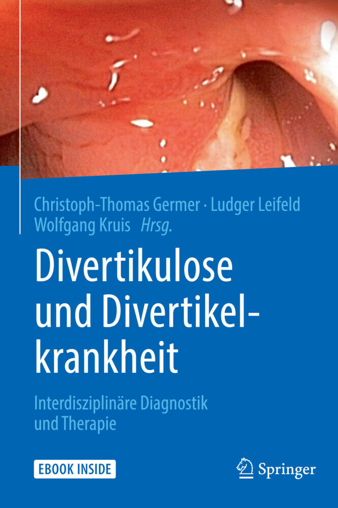 Divertikulose und Divertikelkrankheit