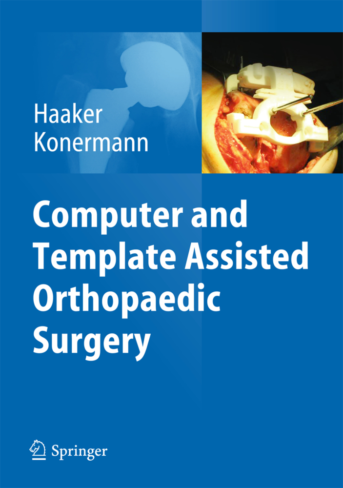 Computer and Template Assisted Orthopedic Surgery