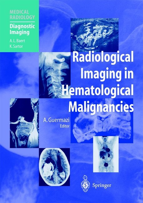 Radiological Imaging in Hematological Malignancies