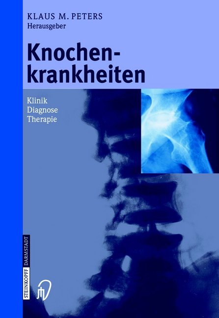 Knochenkrankheiten