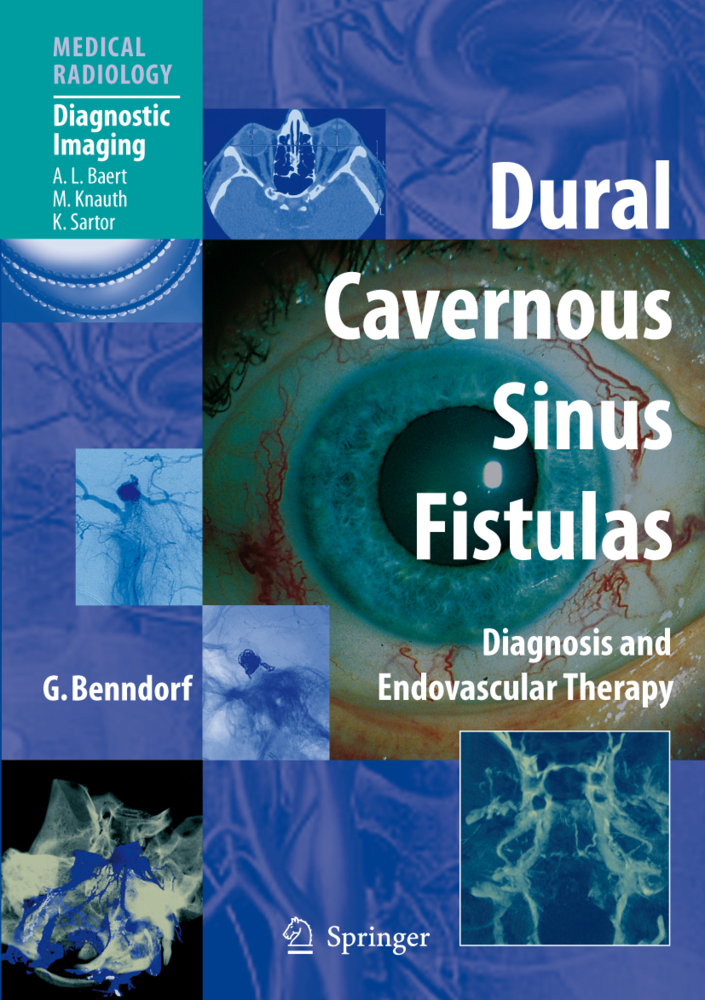 Dural Cavernous Sinus Fistulas