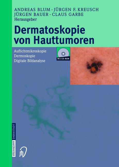 Dermatoskopie von Hauttumoren