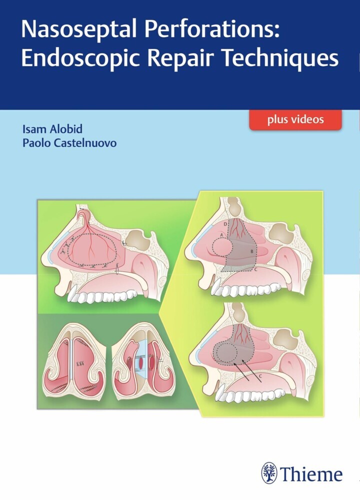 Nasoseptal Perforations: Endoscopic Repair Techniques