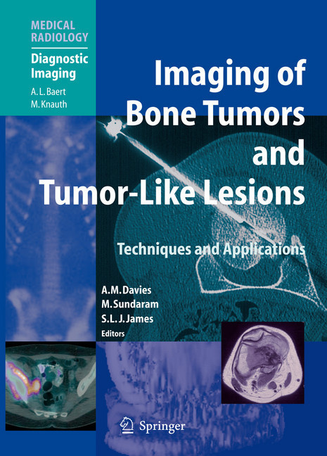 Imaging of Bone Tumors and Tumor-Like Lesions