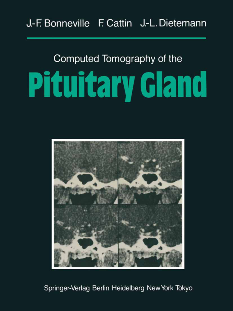 Computed Tomography of the Pituitary Gland