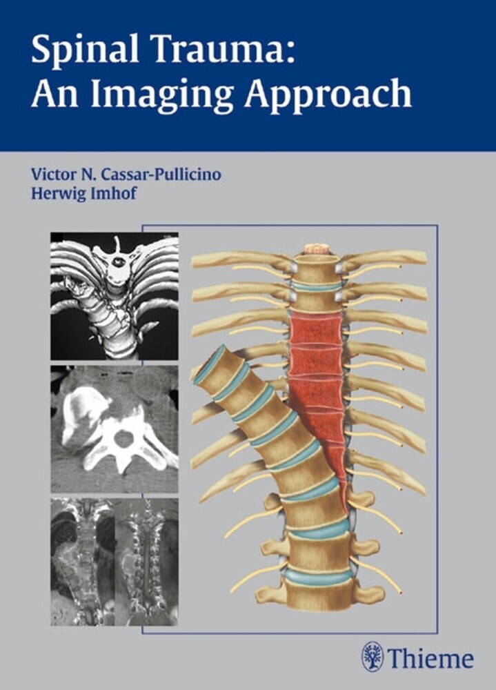 Spinal Trauma - An Imaging Approach