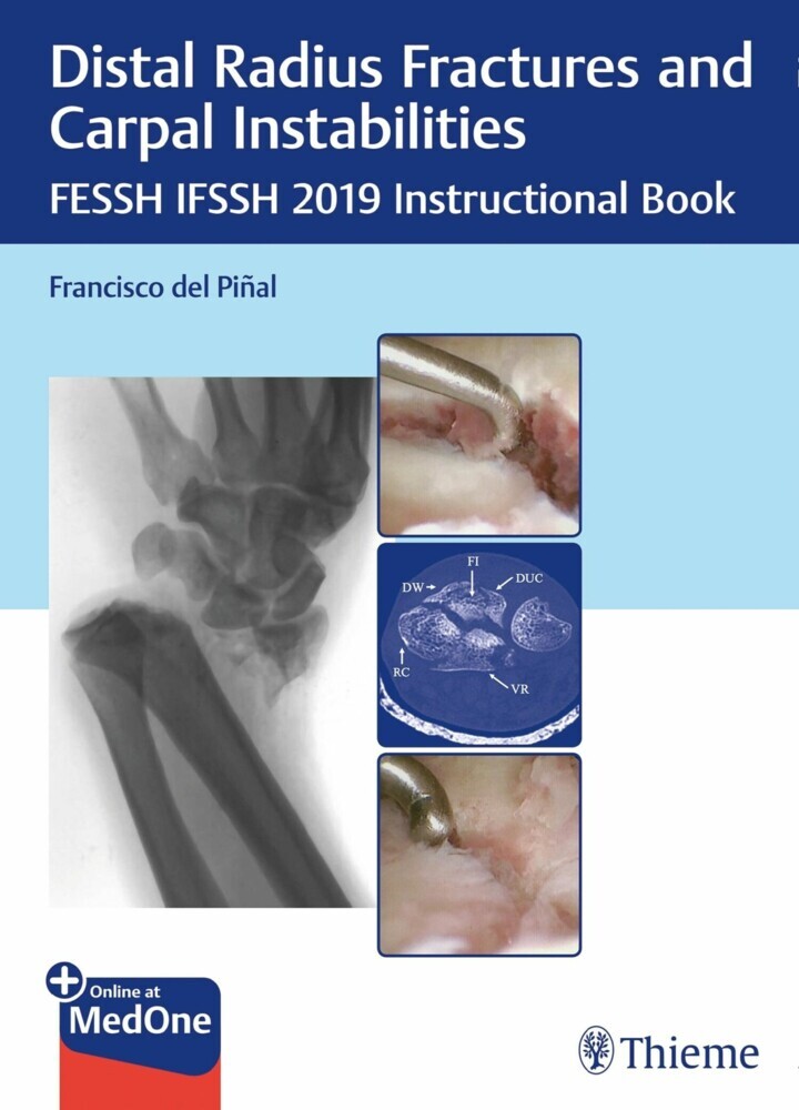 Distal Radius Fractures and Carpal Instabilities