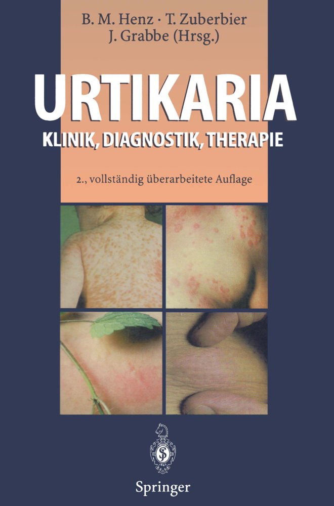 Urtikaria