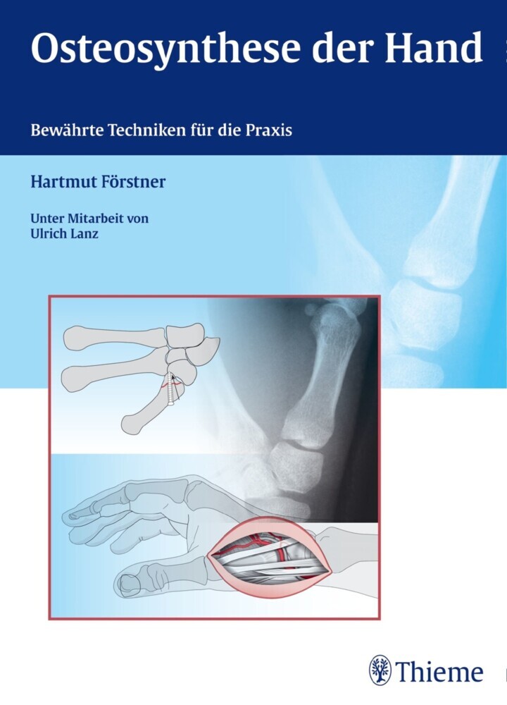 Osteosynthese der Hand