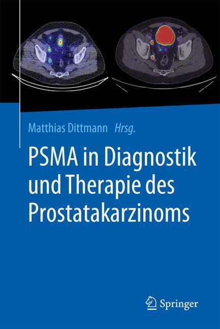 PSMA in Diagnostik und Therapie des Prostatakarzinoms