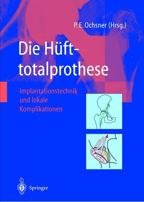 Die Hüfttotalprothese