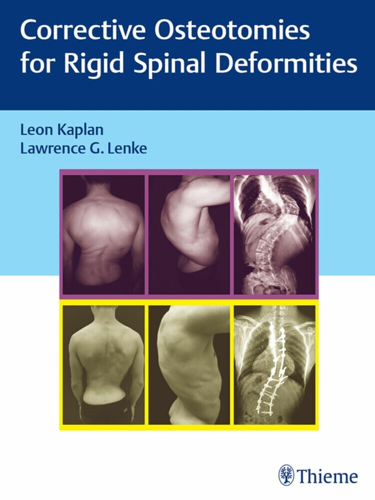 Corrective Osteotomies for Rigid Spinal Deformities