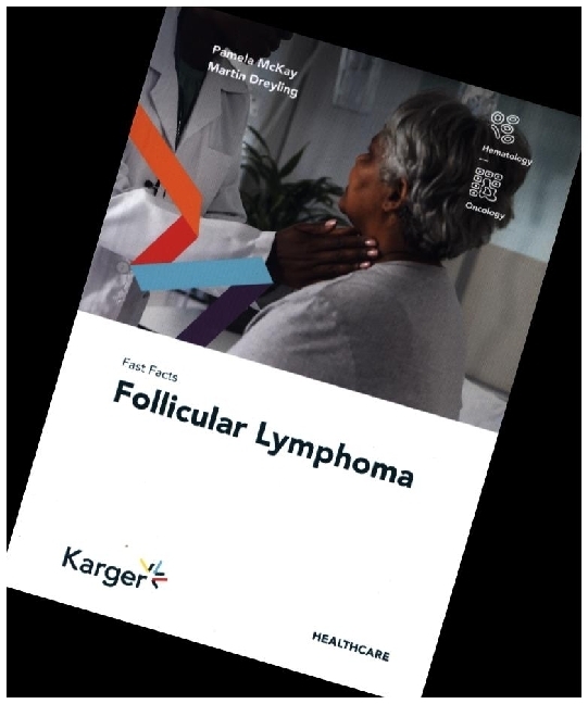 Fast Facts: Follicular Lymphoma