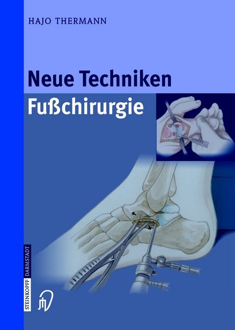 Neue Techniken Fusschirurgie