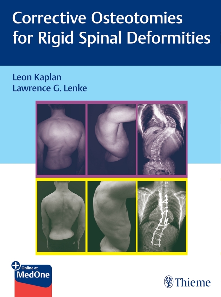 Corrective Osteotomies for Rigid Spinal Deformities