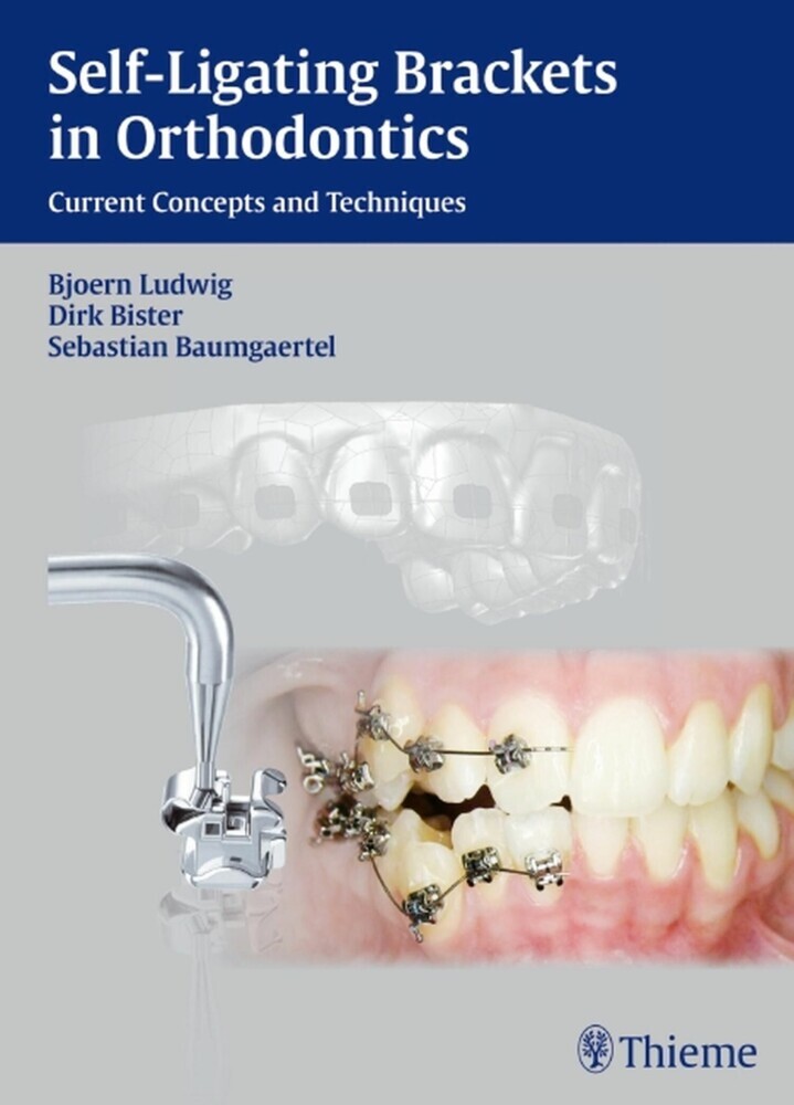 Self-Ligating Brackets in Orthodontics